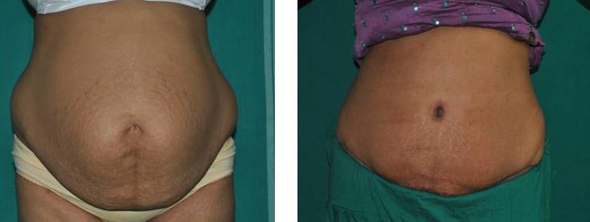 Abdominoplasty for tummy tuck in Kerala, India